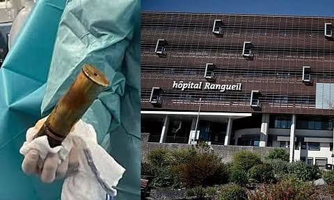 ஆசனவாயில் பீரங்கி குண்டு..! திகைத்து போன டாக்டர்கள்...! பயங்கர வைரல்...!